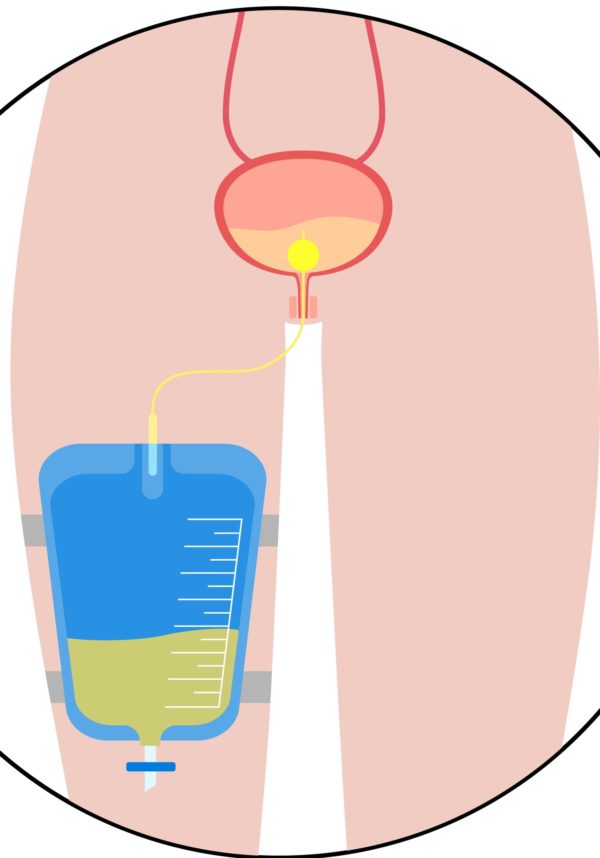 Foley Catheter And Suprapubic Catheter Illustrated Nursing