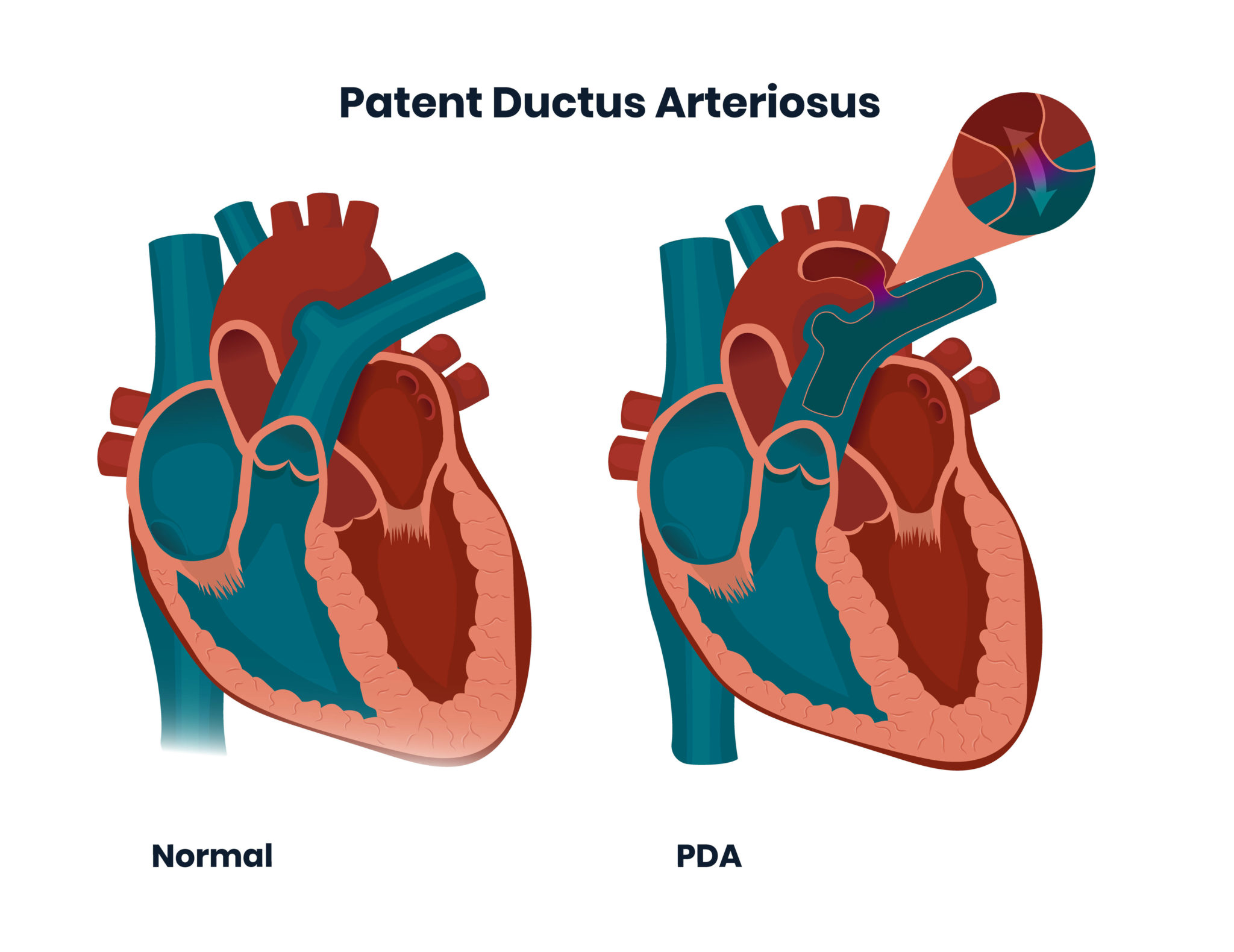Patent Ductus Arteriosus – Pass the NCLEX RN with Illustrated Nursing