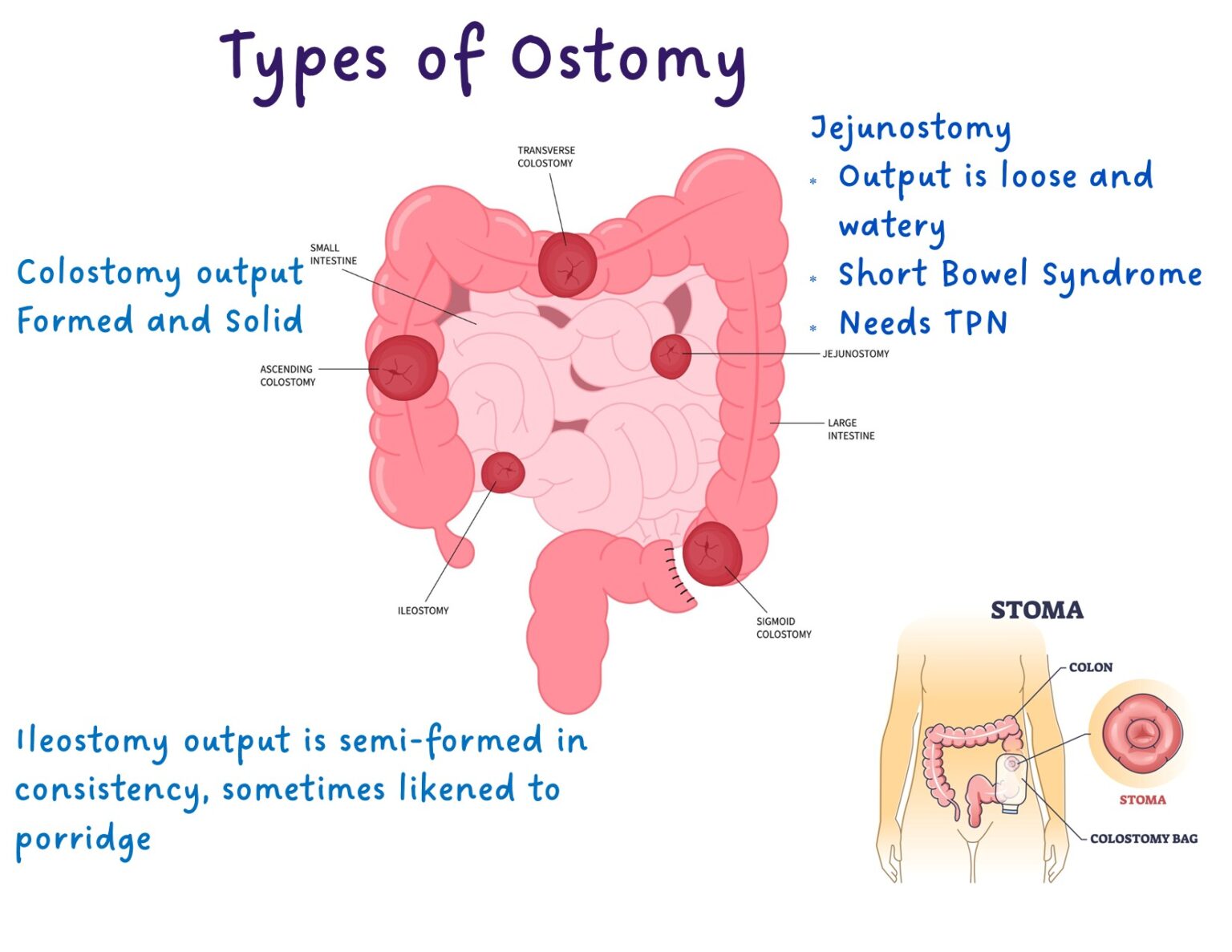 Colostomy Care Illustrated Nursing 