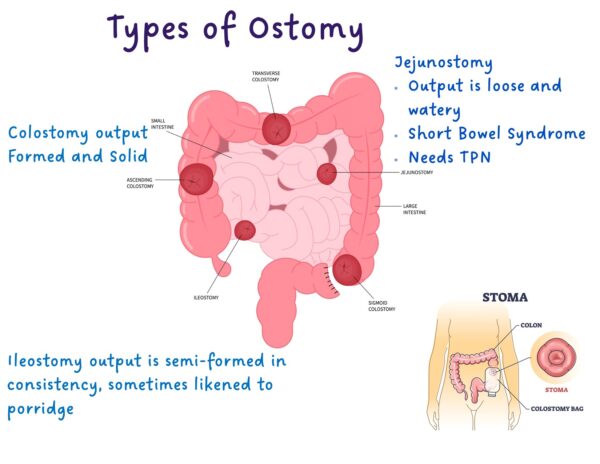 Colostomy Care – Illustrated Nursing