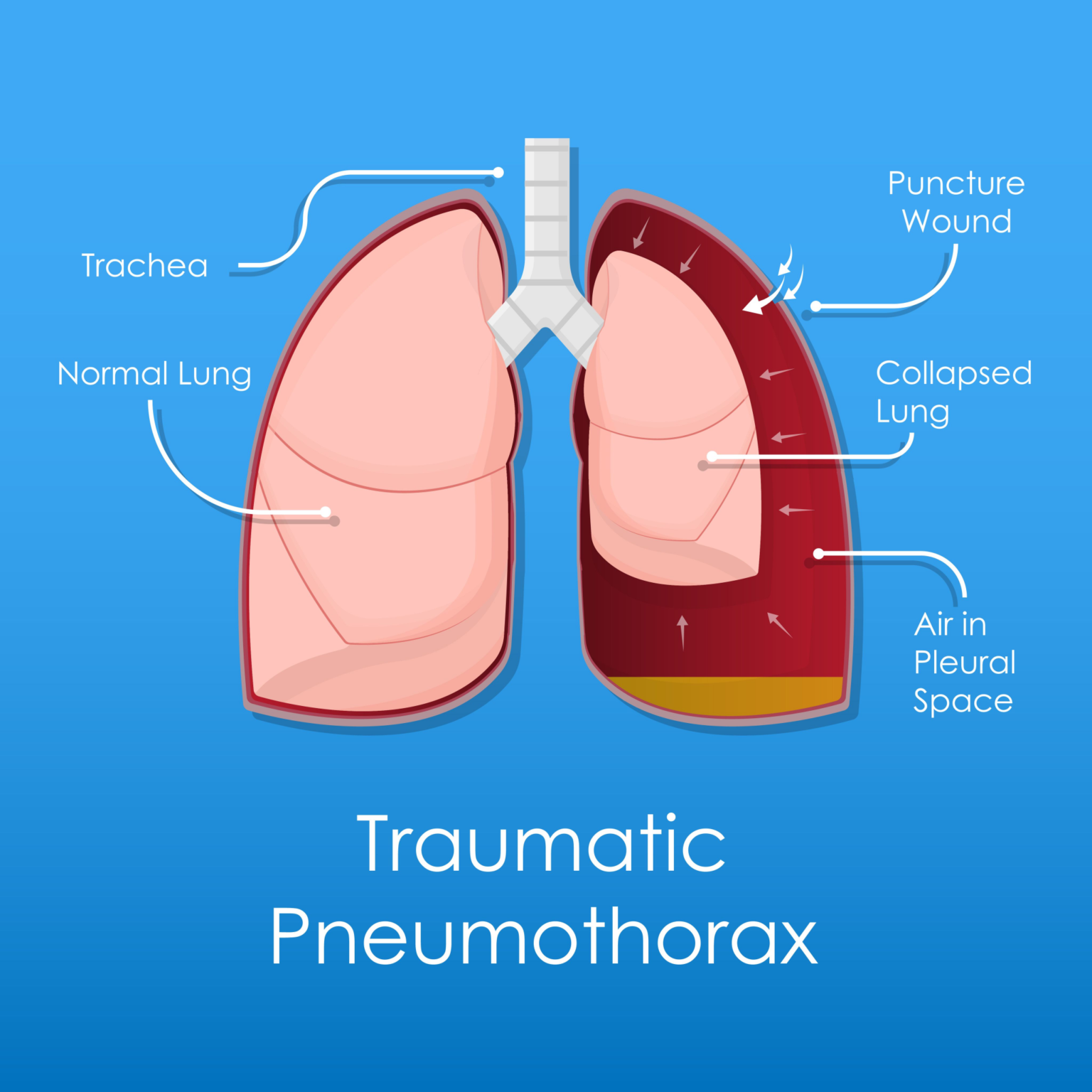 Chest Tube Care – Illustrated Nursing