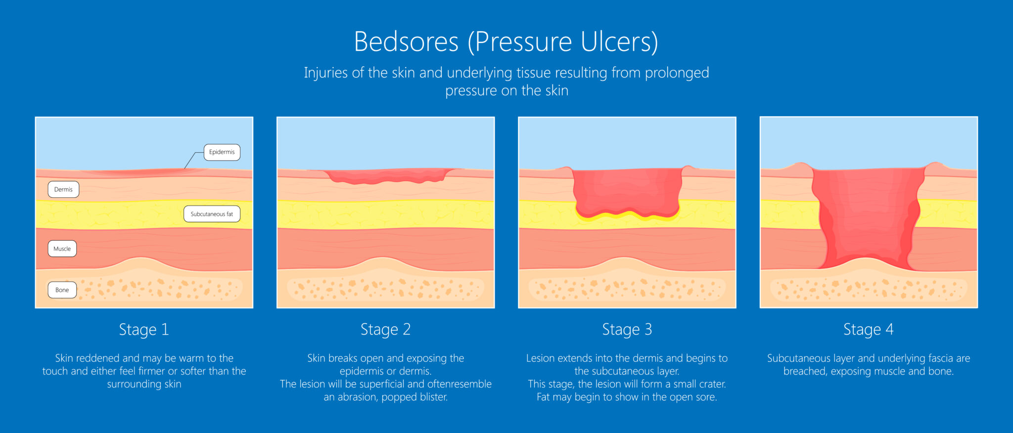 pressure-sores-pass-the-nclex-rn-with-illustrated-nursing