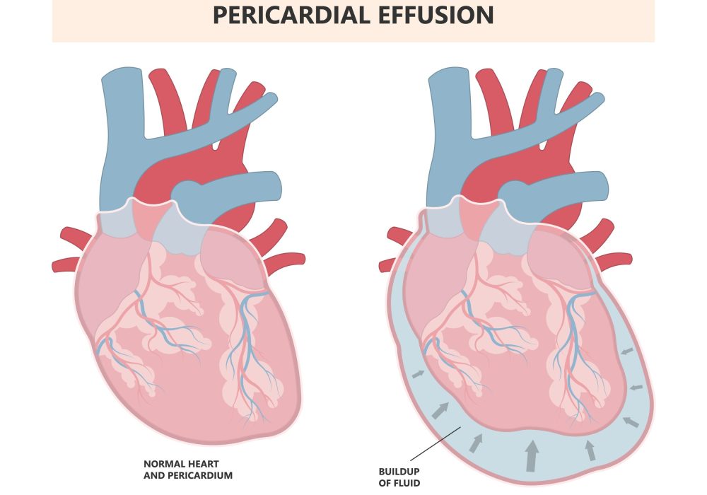 pericardiaeffusion