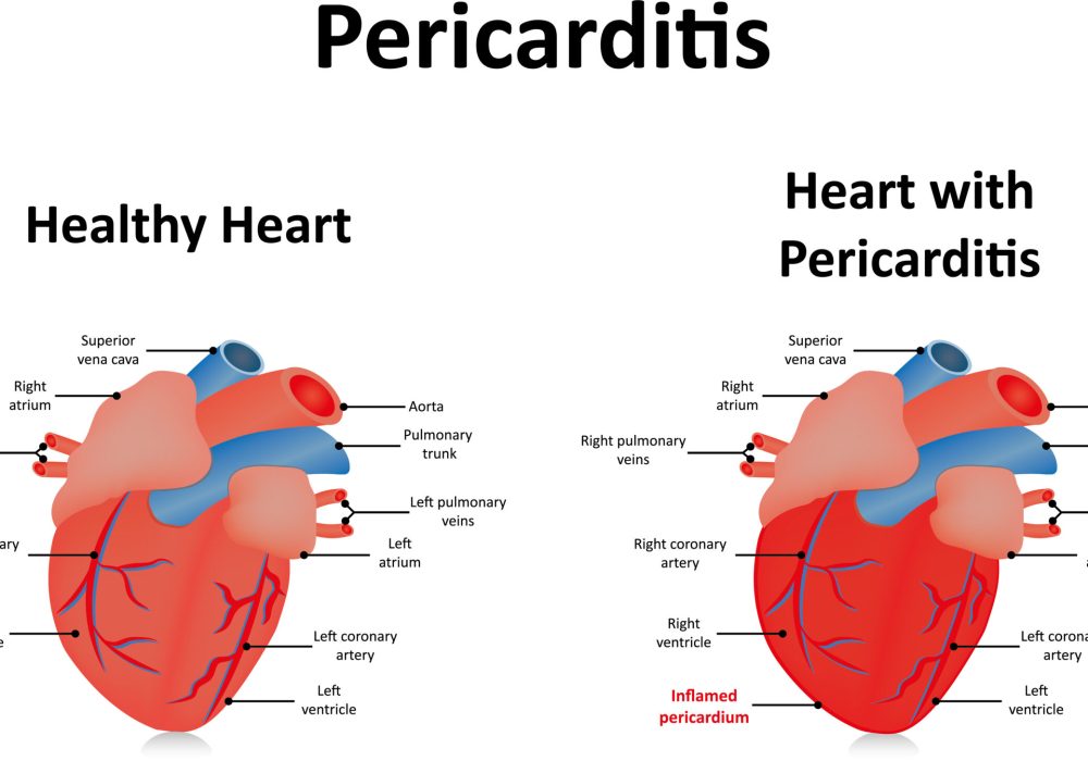 Pericarditis